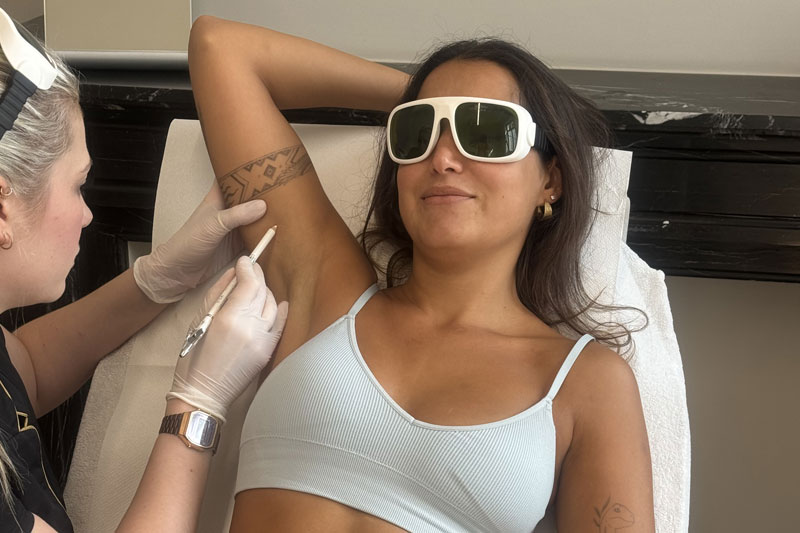 epilation laser peau foncee epilia wemmel